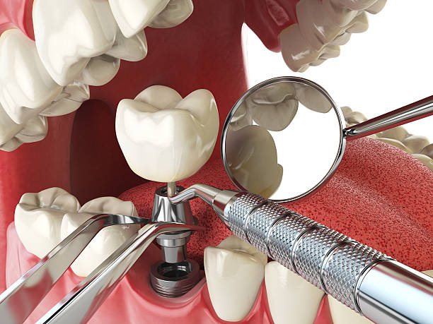 Best Tooth Infection Emergency Dentist  in Chieand, FL